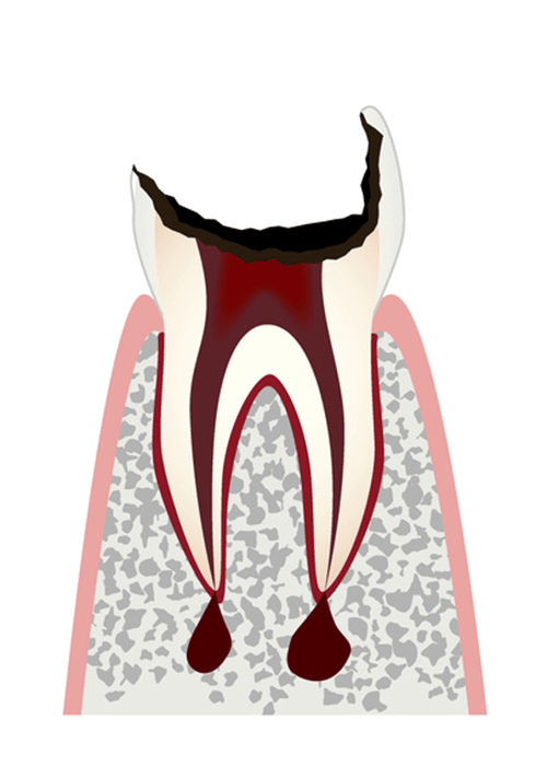 歯の内部（象牙質）まで進行した虫歯