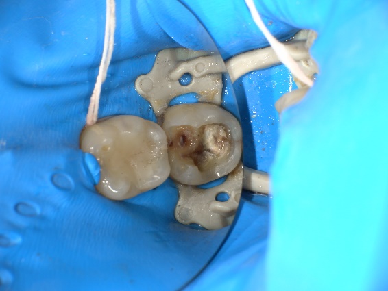 ダイレクトボンディング治療前