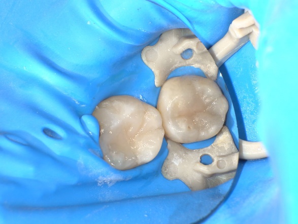 ダイレクトボンディング治療後