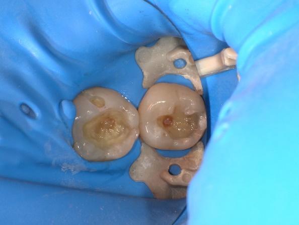 ダイレクトボンディング治療前