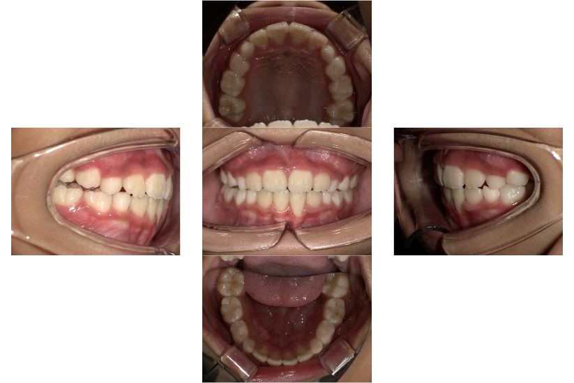 マイオブレース矯正治療後