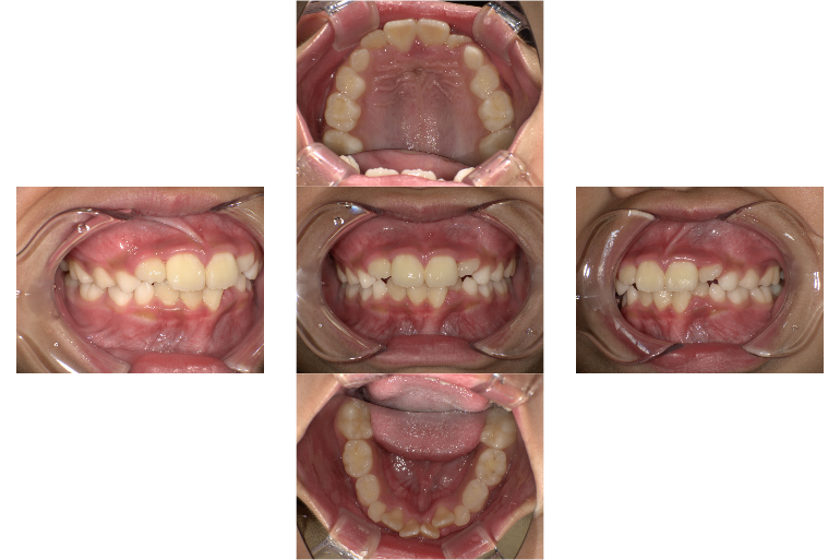 マイオブレース治療前