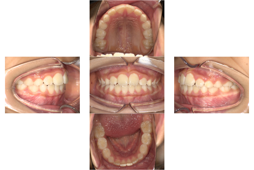 マイオブレース矯正治療後