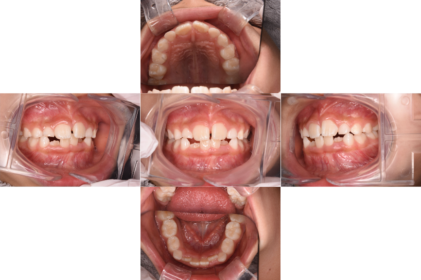 マイオブレース治療前