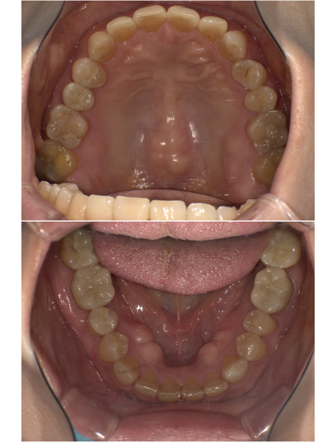 オフィスホワイトニングプラスafter