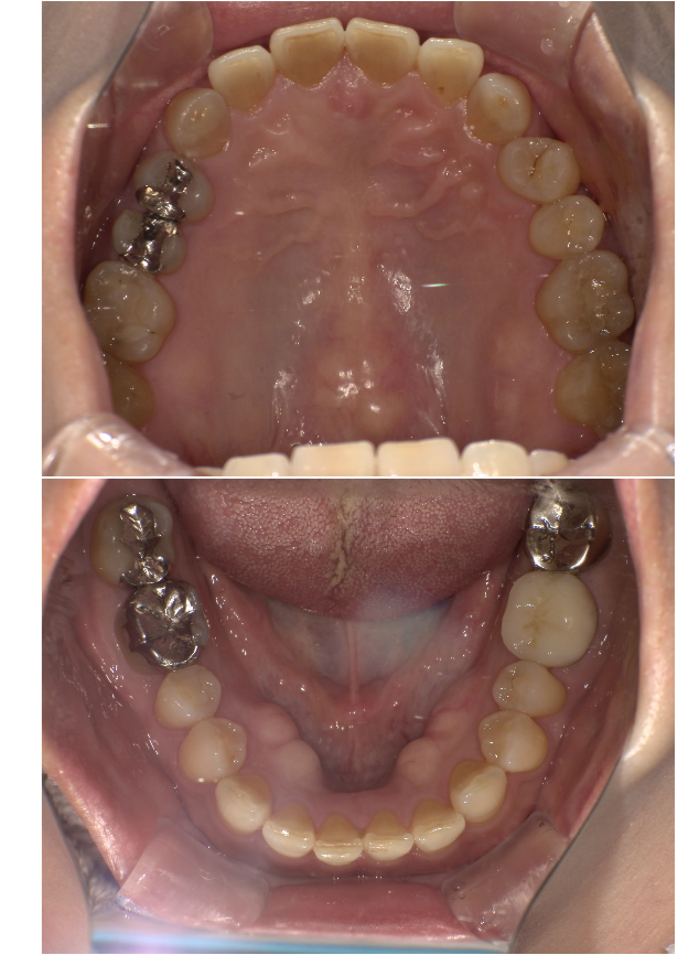 オフィスホワイトニングプラスbefore