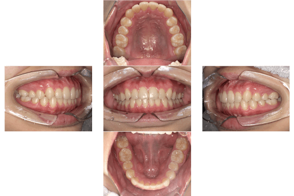 マウスピース矯正治療後