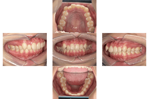 マウスピース矯正治療前