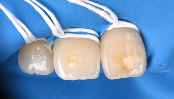 icon(アイコン)治療前