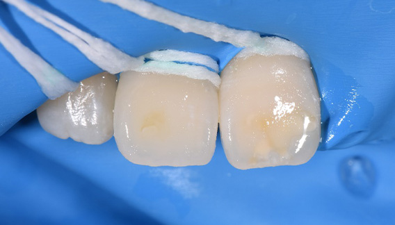 icon(アイコン)治療後