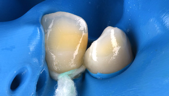 icon(アイコン)治療後